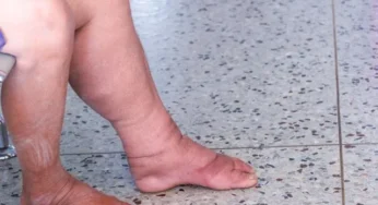 Di 2025, 6 Kasus Filariasis Ditemukan di Mimika 