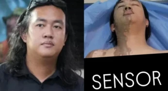 Andrie Yunus Jadi Korban Penyiraman Air Keras